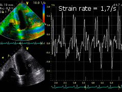 How to do strain echocardiogram ❤️✨ 