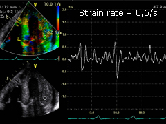 How to do strain echocardiogram ❤️✨ 